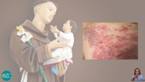 Statua religiosa sfumata e fotografia di una lesione cutanea da Herpes Zoster, usata per spiegare la differenza tra tradizione del “segnare” e supporto medico.